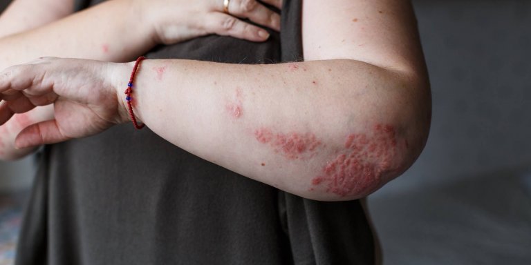 rsz_dreamstime_xxl_111841600_psoriasis